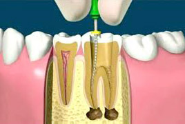 Endodonzia Studio Dentistico Ballarin Schio